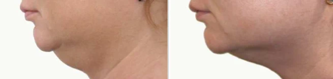 Resultados de enzimas PB Serum