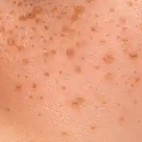 Lentigos