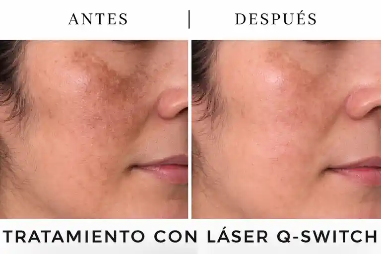 Tratamiento de manchas en la piel en Buenos Aires