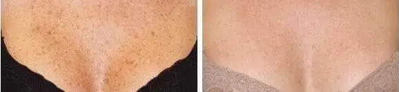 Paciente después del tratamiento con láser Erbium