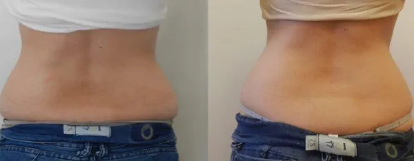 Resultados de tratamiento de flacidez corporal