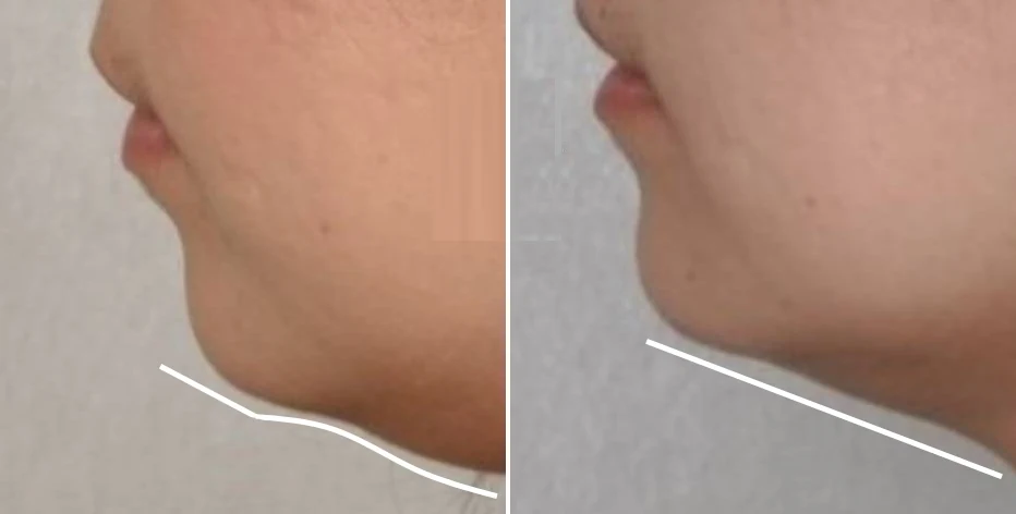 Procedimiento con enzimas PB Serum