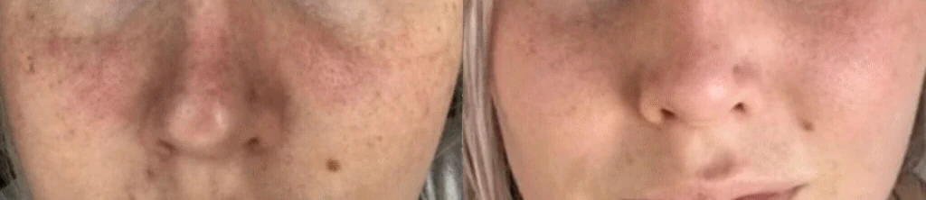 Procedimiento de PRP en el rostro