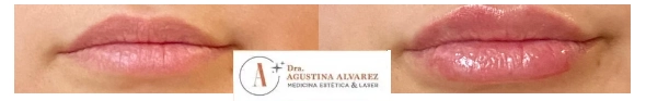 Resultados de relleno de labios