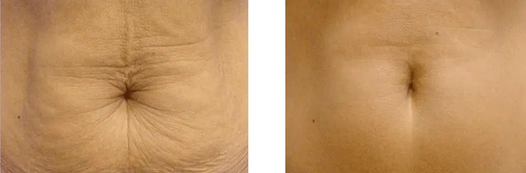 Sculptra Abdomen