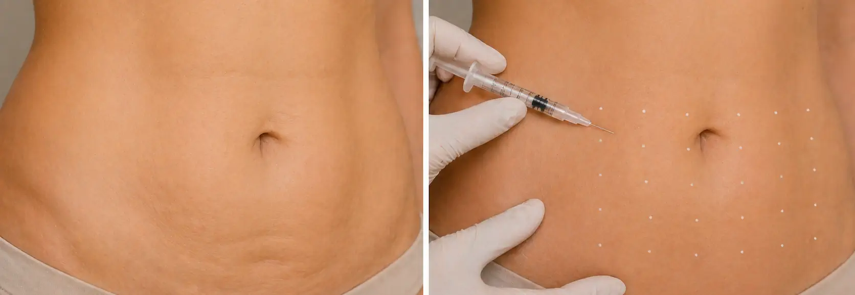 Radiesse Abdomen